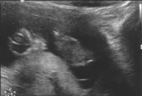 My first scan